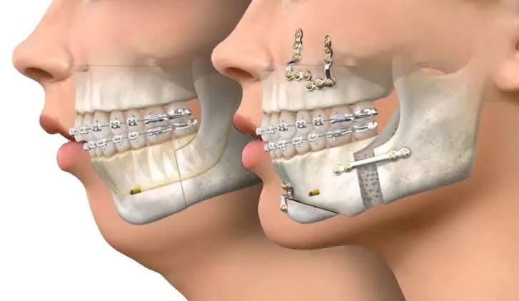 cirurgia ortognática 3d